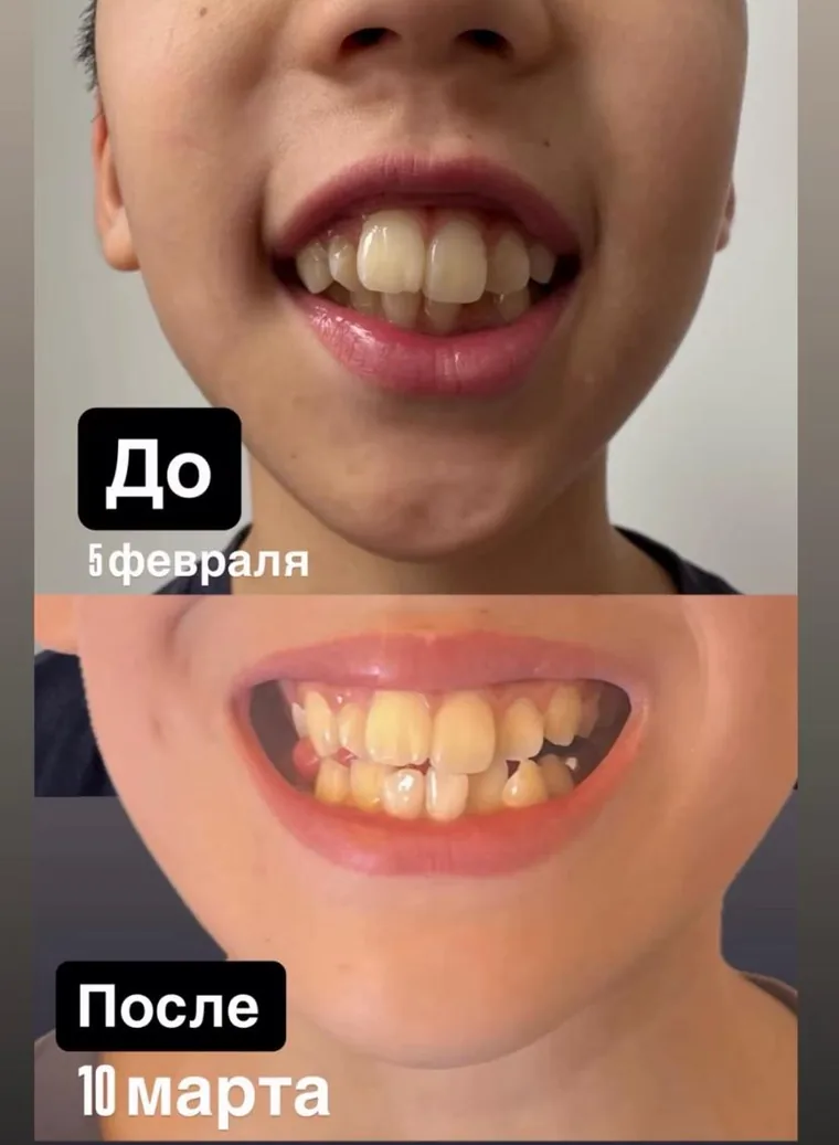 Logo_aba, результат занятий: смыкание зубов до и после